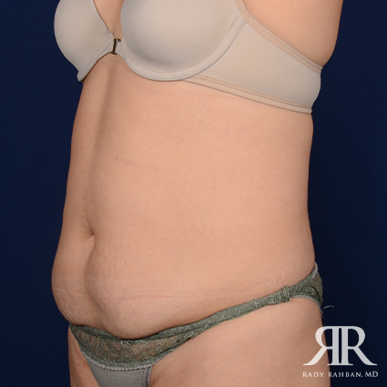 Tummy Tuck