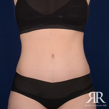 Tummy Tuck