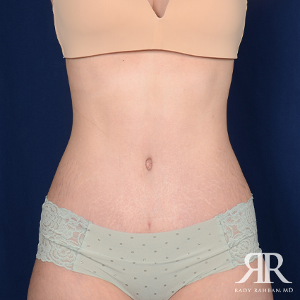 Tummy Tuck