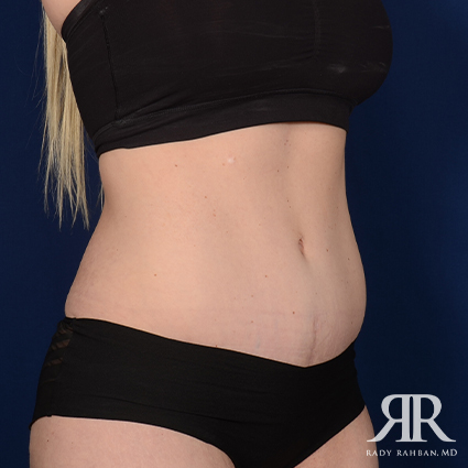 Tummy Tuck