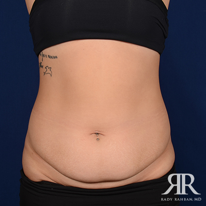 Tummy Tuck