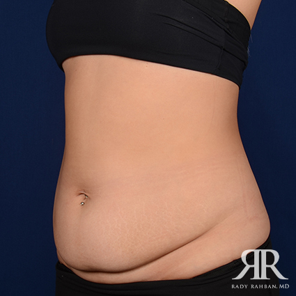 Tummy Tuck