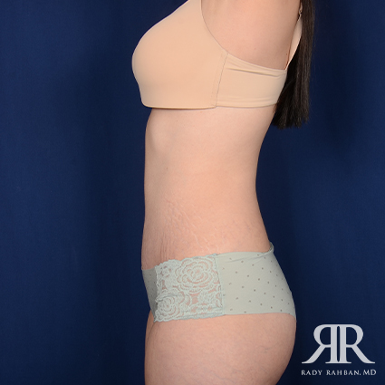 Tummy Tuck