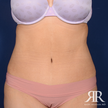 Tummy Tuck