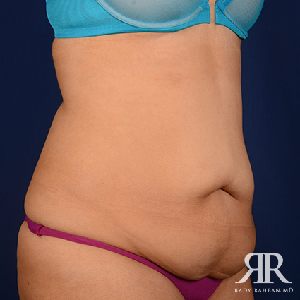 Tummy Tuck