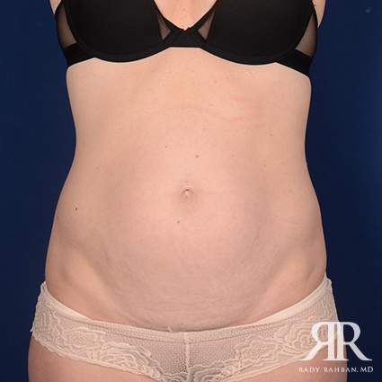 Tummy Tuck