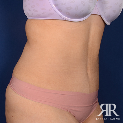 Tummy Tuck