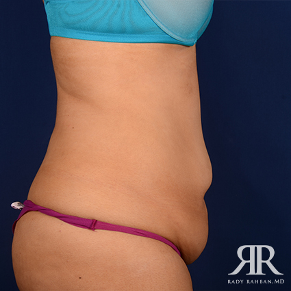 Tummy Tuck