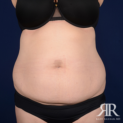 Tummy Tuck