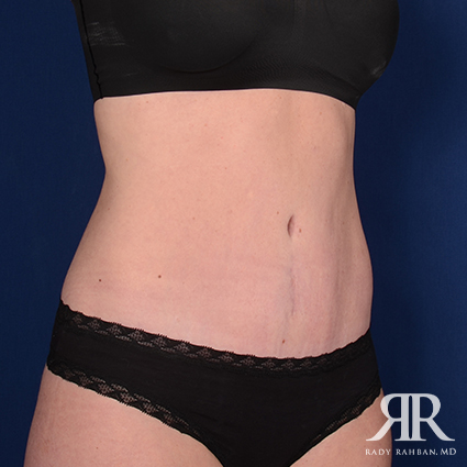 Tummy Tuck