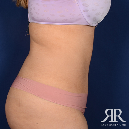 Tummy Tuck