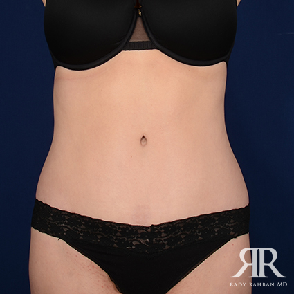 Tummy Tuck