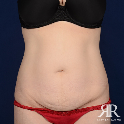 Tummy Tuck