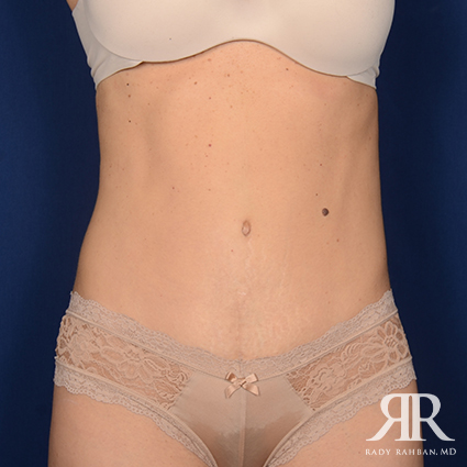 Tummy Tuck