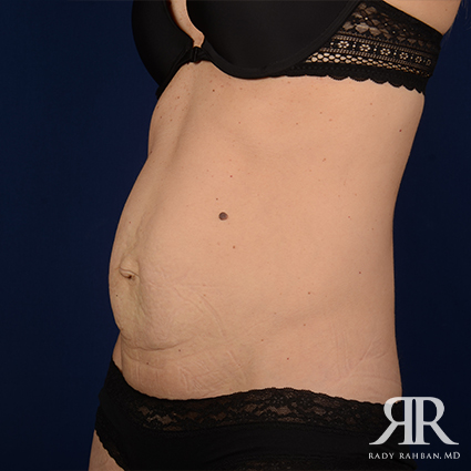 Tummy Tuck