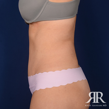 Tummy Tuck