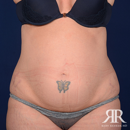 Tummy Tuck