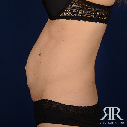 Tummy Tuck