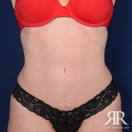 Tummy Tuck