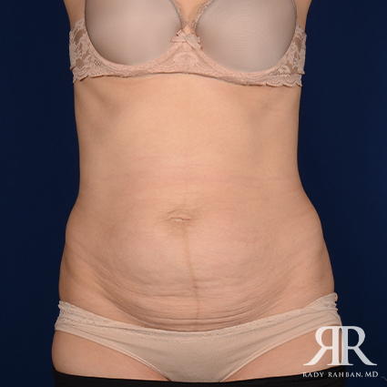 Tummy Tuck