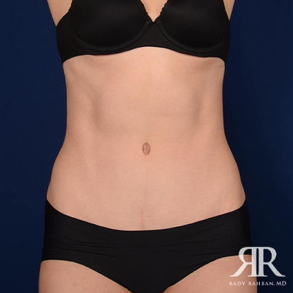 Tummy Tuck