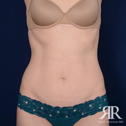 Tummy Tuck