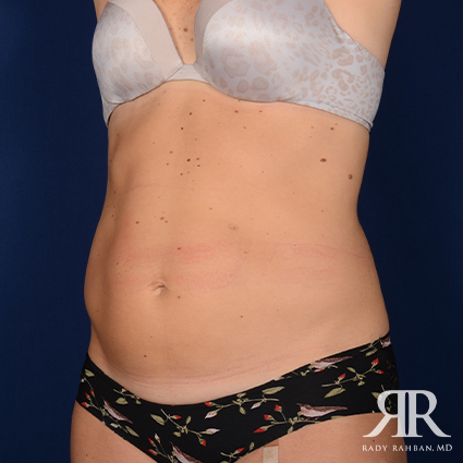 Tummy Tuck