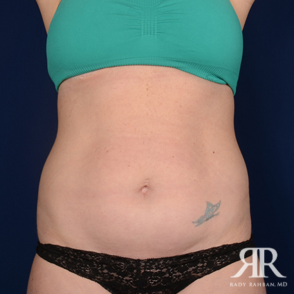 Tummy Tuck