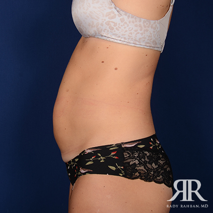 Tummy Tuck