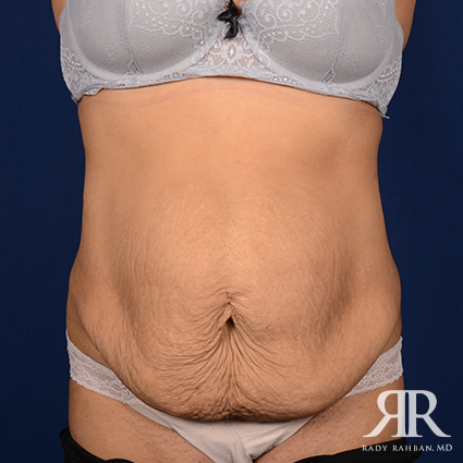 Tummy Tuck