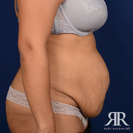 Tummy Tuck