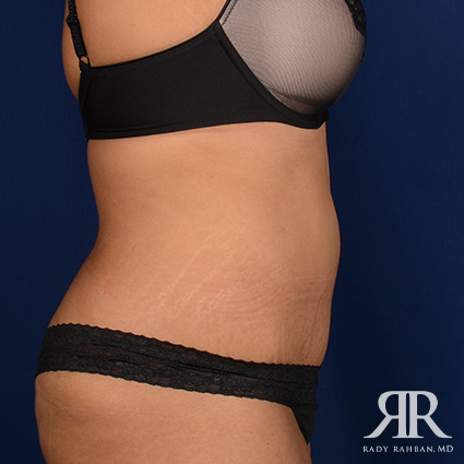 Tummy Tuck