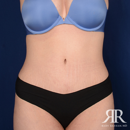 Severe Diastasis Recti