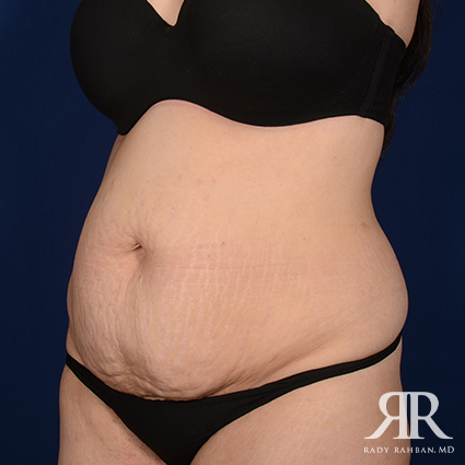 Severe Diastasis Recti