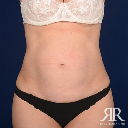 Severe Diastasis Recti