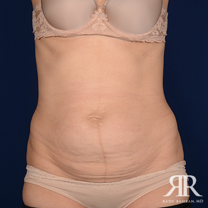 Severe Diastasis Recti