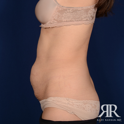 Severe Diastasis Recti