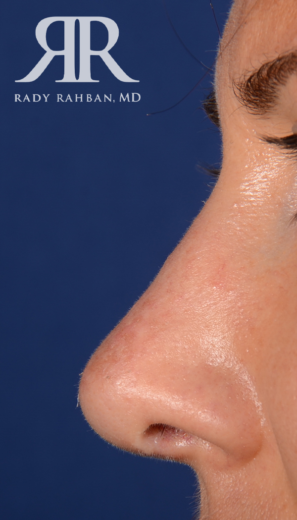 Rhinoplasty Close up