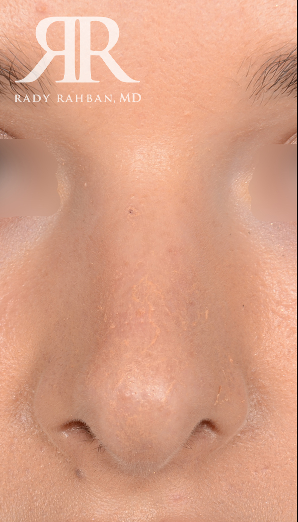 Rhinoplasty Close up