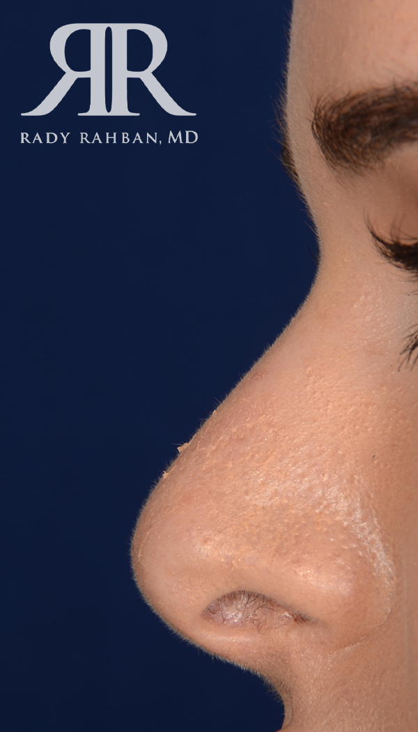 Rhinoplasty Close up