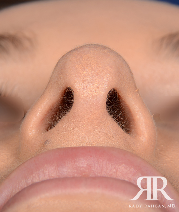 Rhinoplasty Close up