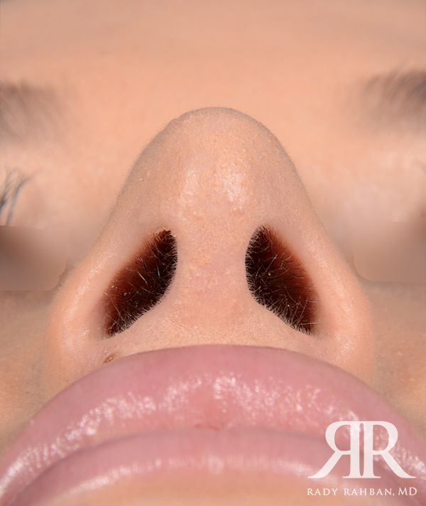 Rhinoplasty Close up