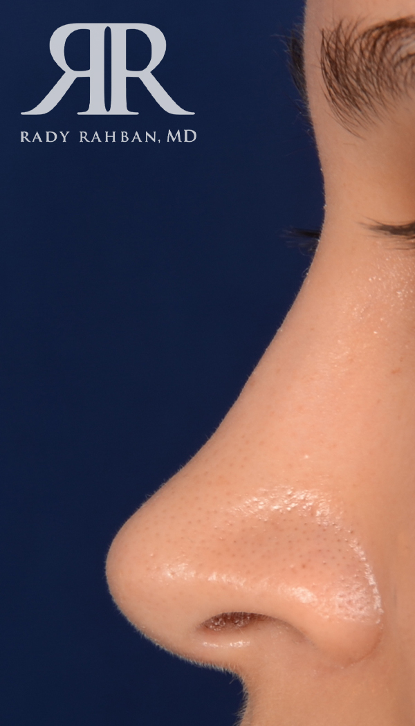 Rhinoplasty Close up