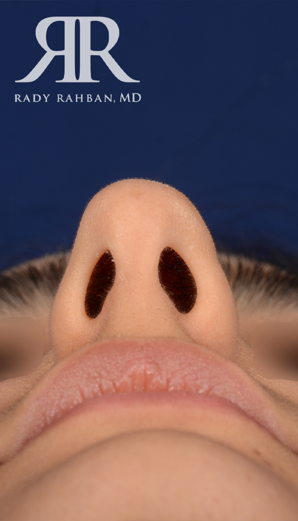 Rhinoplasty Close up