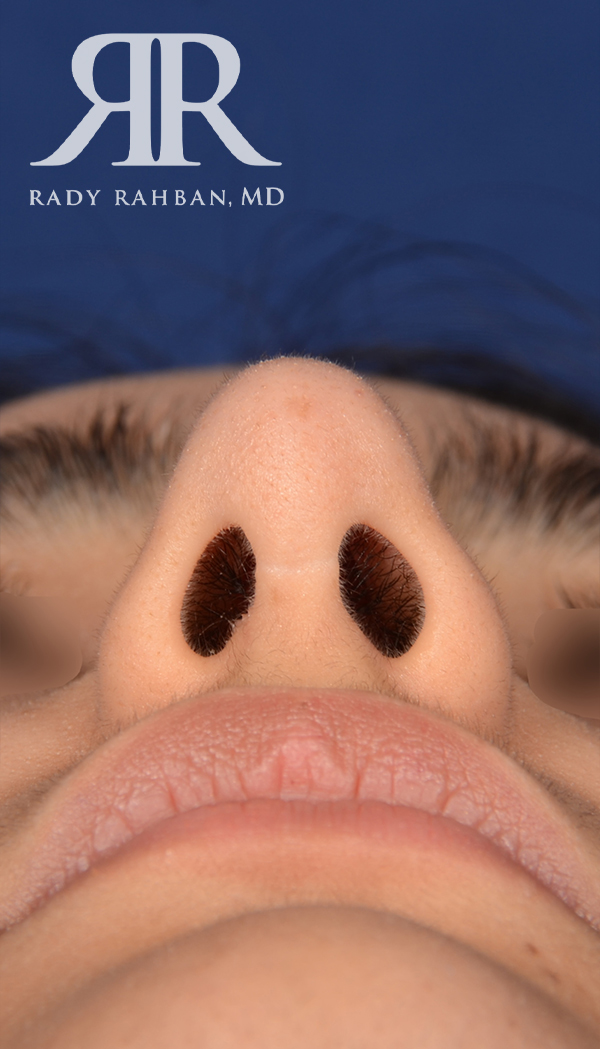 Rhinoplasty Close up