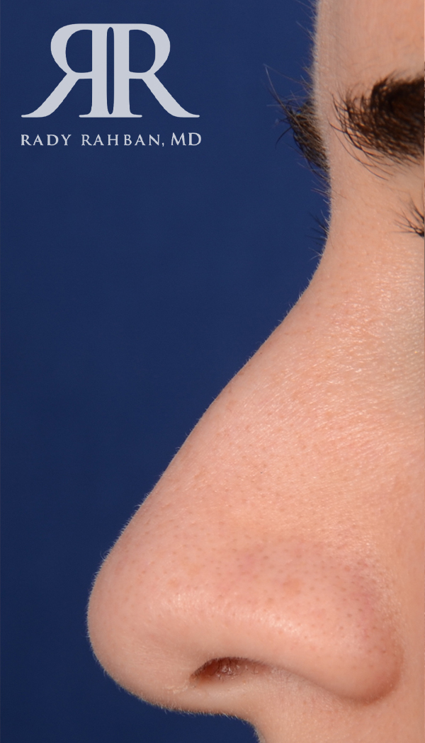 Rhinoplasty Close up