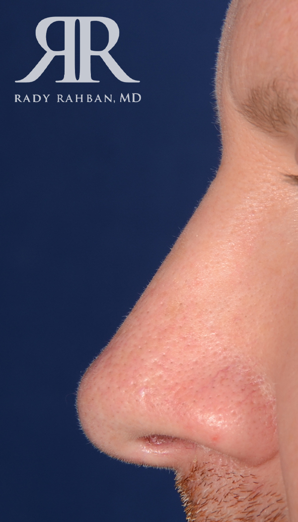 Rhinoplasty Close up