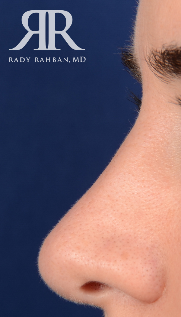 Rhinoplasty Close up