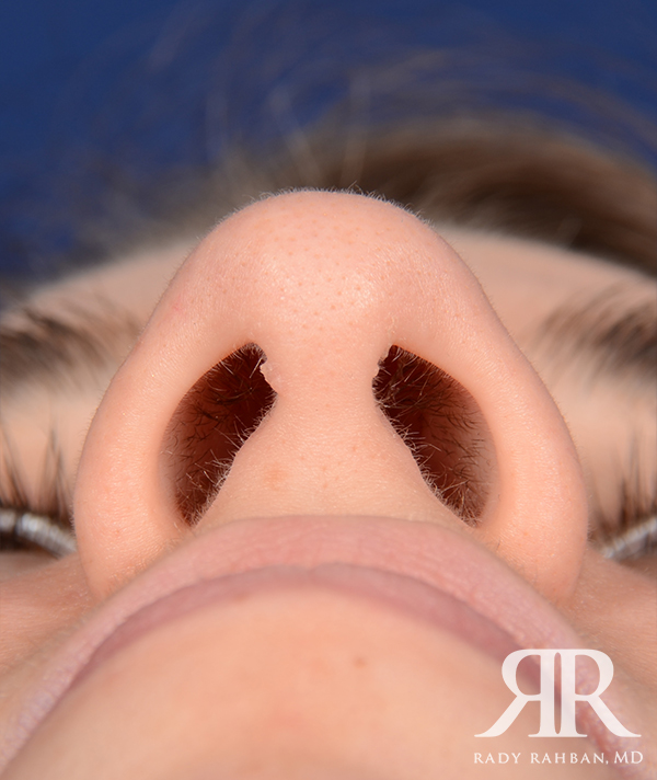 Rhinoplasty Close up