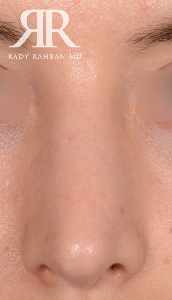 Rhinoplasty Close up